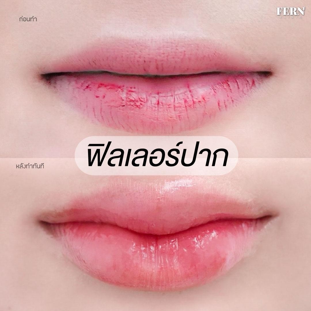 LINE_ALBUM_เคสรีวิว FILLER_250927_3