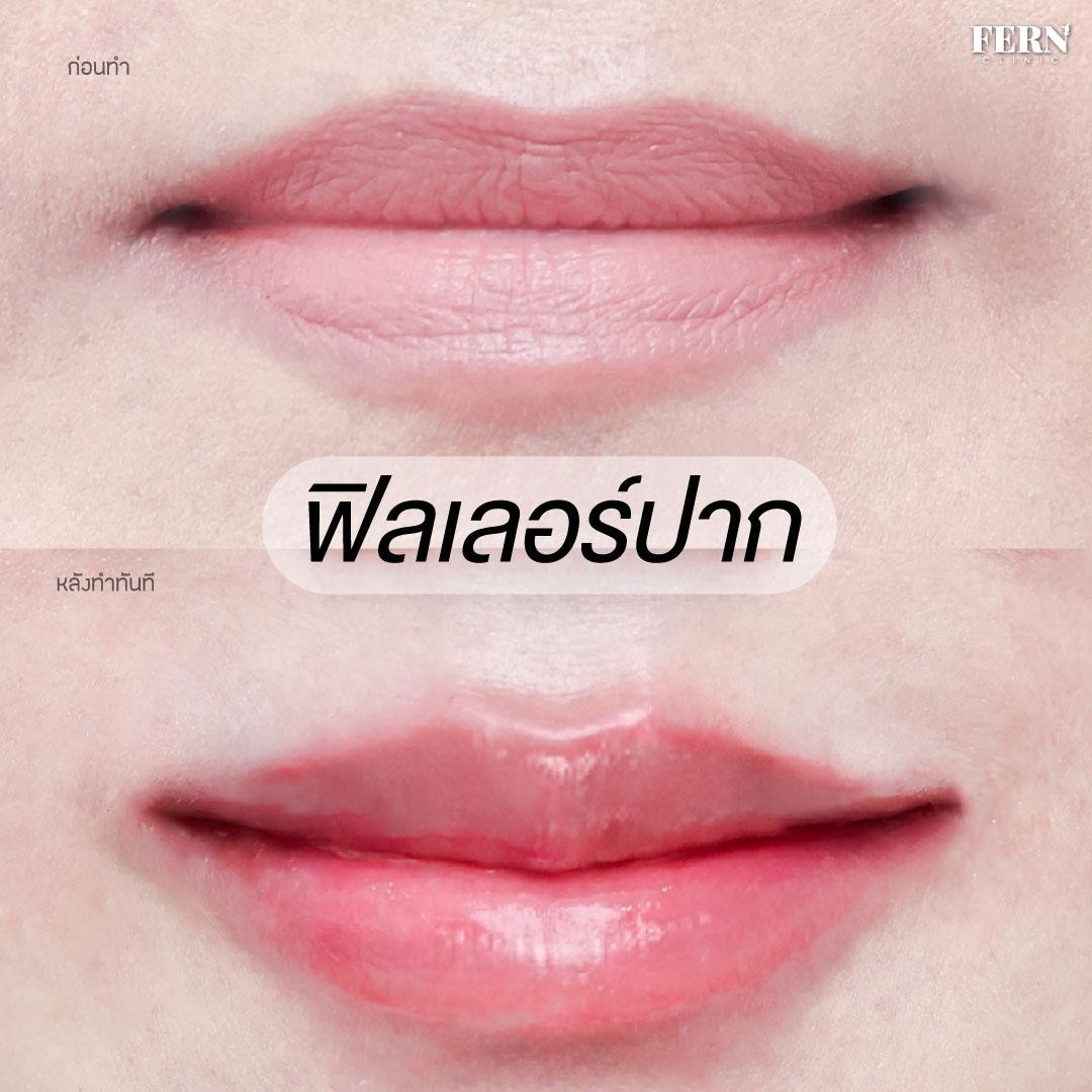 LINE_ALBUM_เคสรีวิว FILLER_250927_4