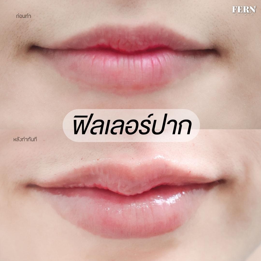 LINE_ALBUM_เคสรีวิว FILLER_250927_5