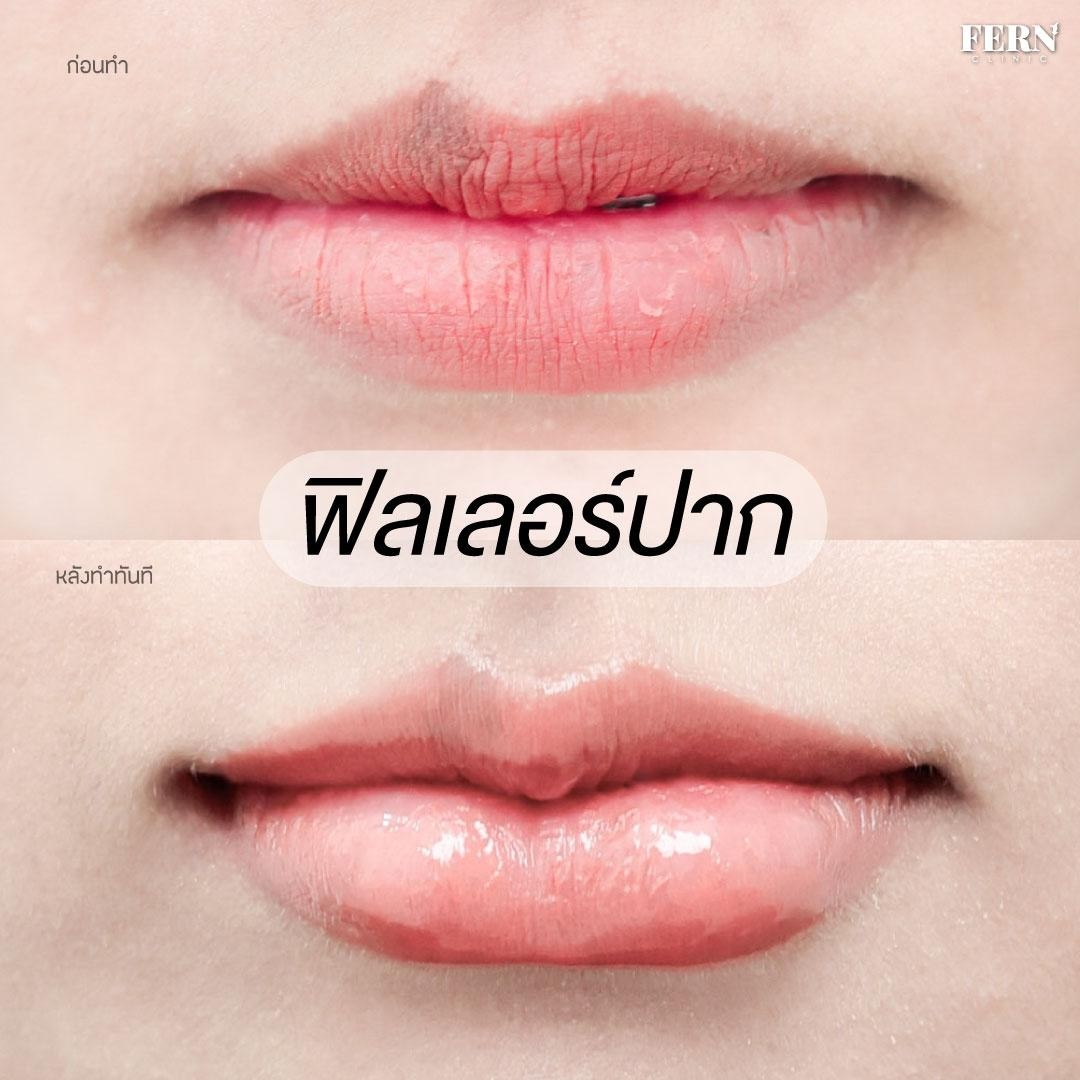 LINE_ALBUM_เคสรีวิว FILLER_250927_6