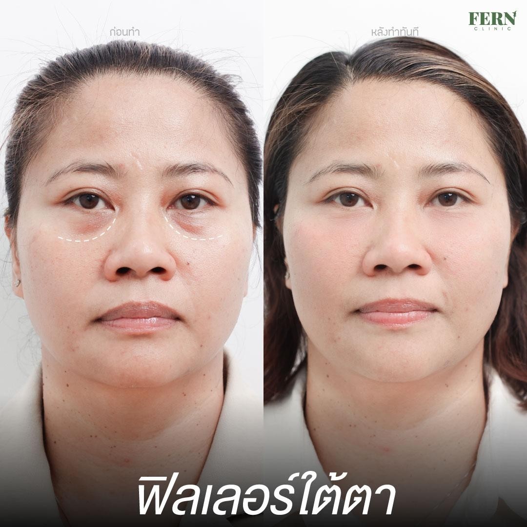 LINE_ALBUM_เคสรีวิว FILLER_250927_8