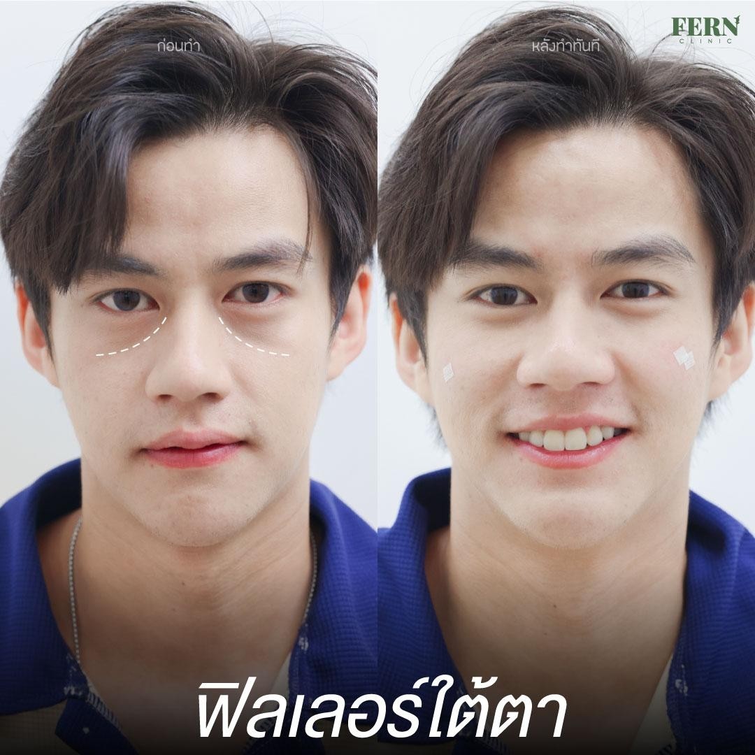 LINE_ALBUM_เคสรีวิว FILLER_250927_9