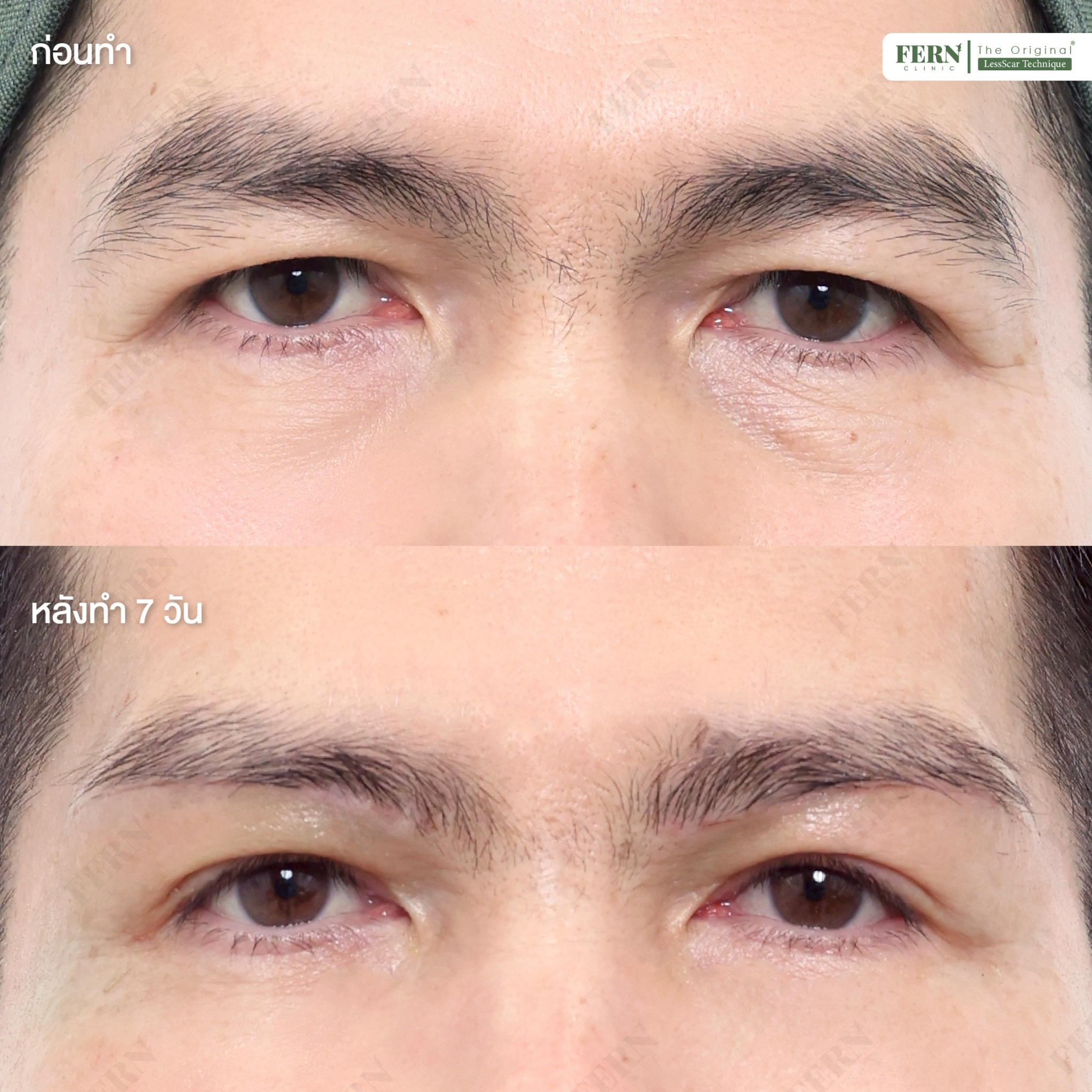 LINE_ALBUM_เคสรีวิว SBL_250926_7