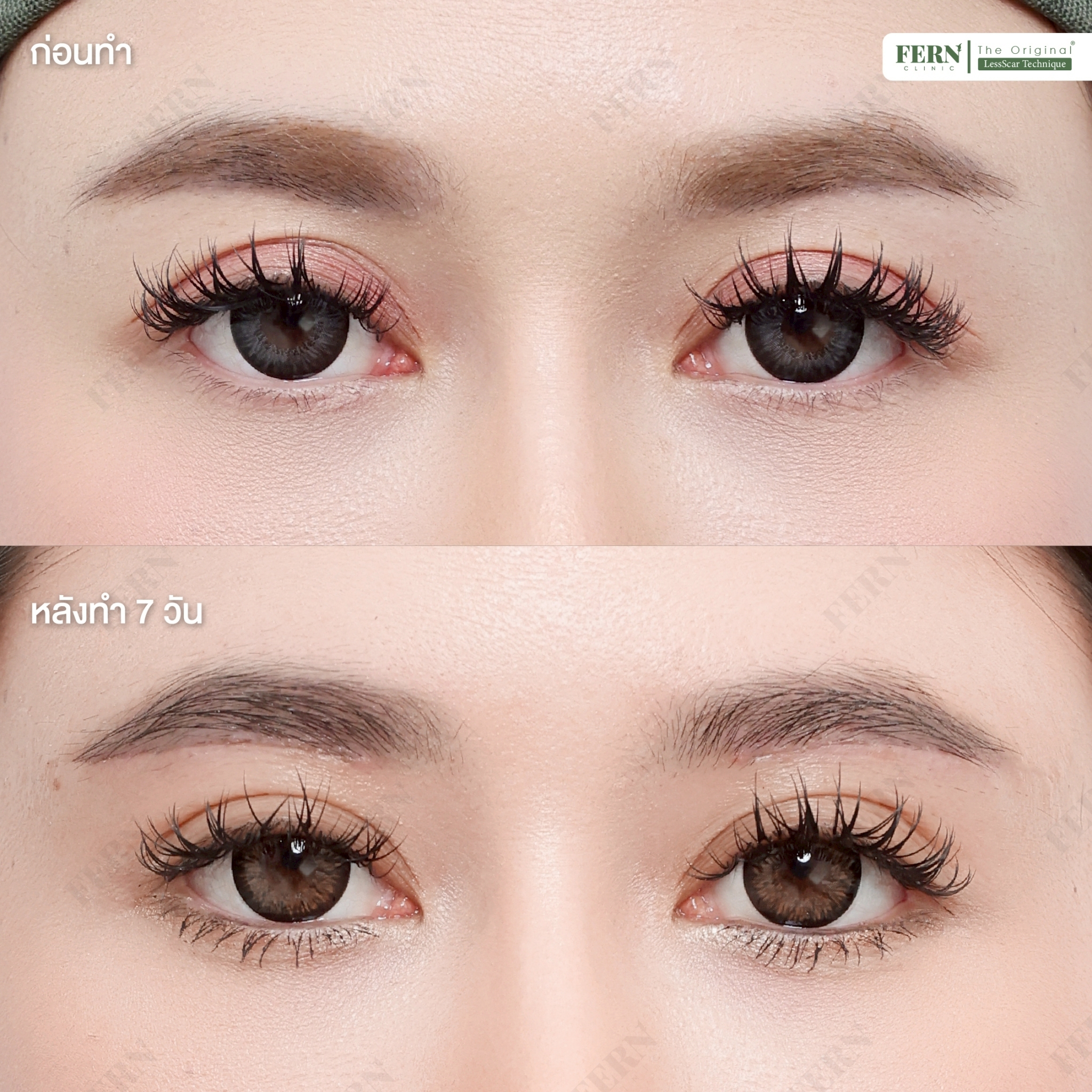 LINE_ALBUM_เคสรีวิว SBL_250926_8