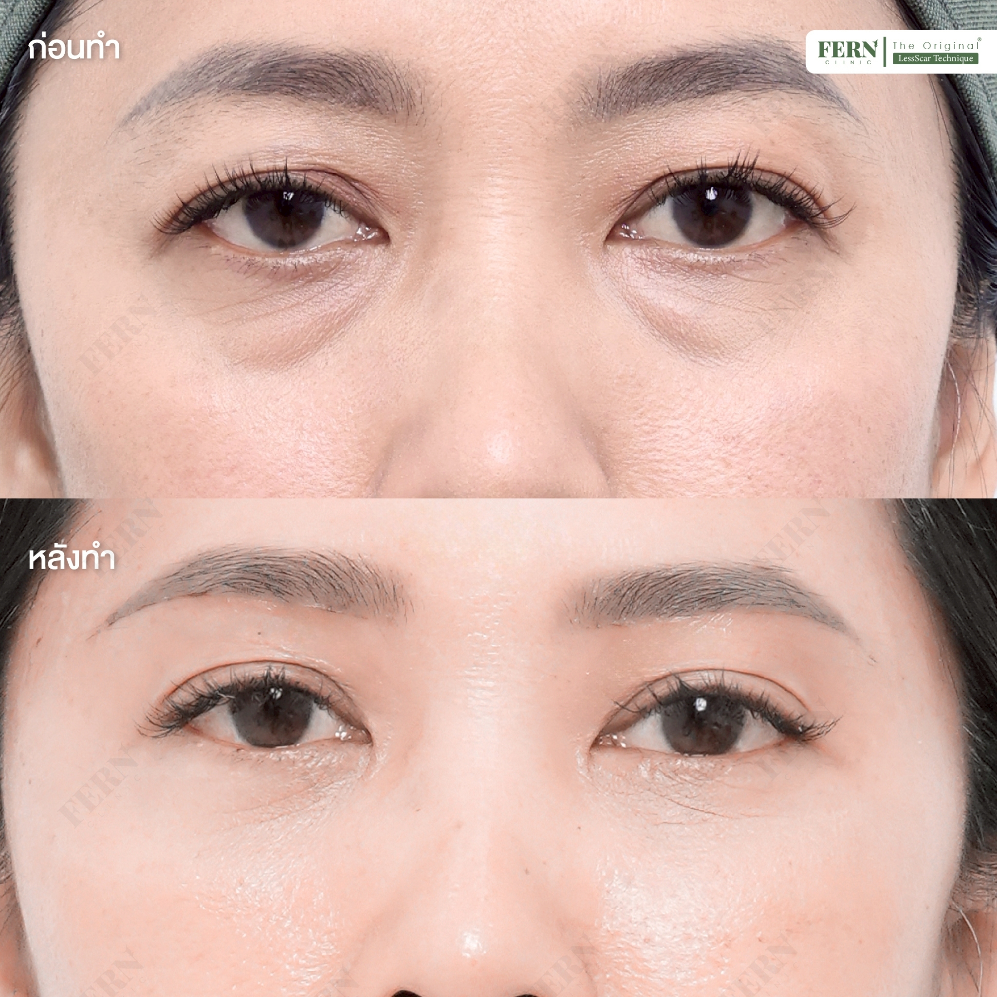 LINE_ALBUM_เคสรีวิว ตัดถุงใต้ตา_250927_1