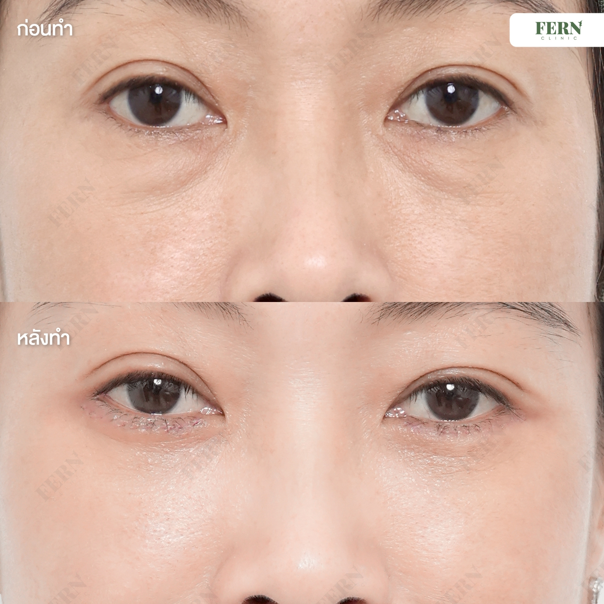 LINE_ALBUM_เคสรีวิว ตัดถุงใต้ตา_250927_8