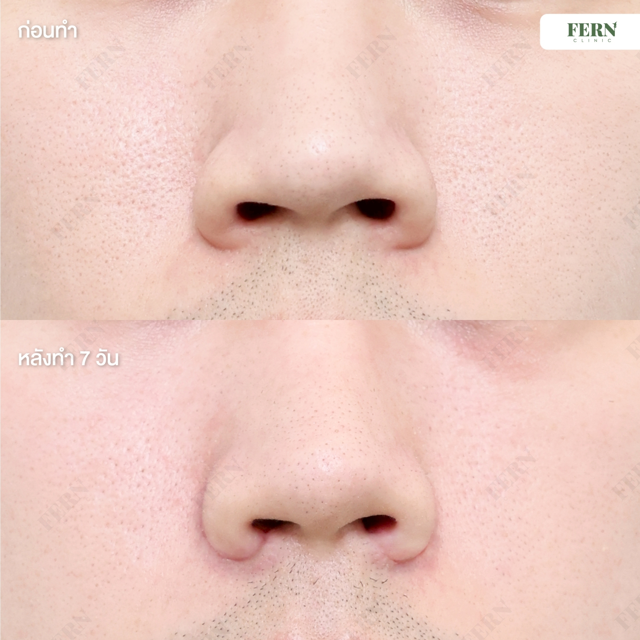 LINE_ALBUM_เคสรีวิว ตัดปีกจมูก_250927_1