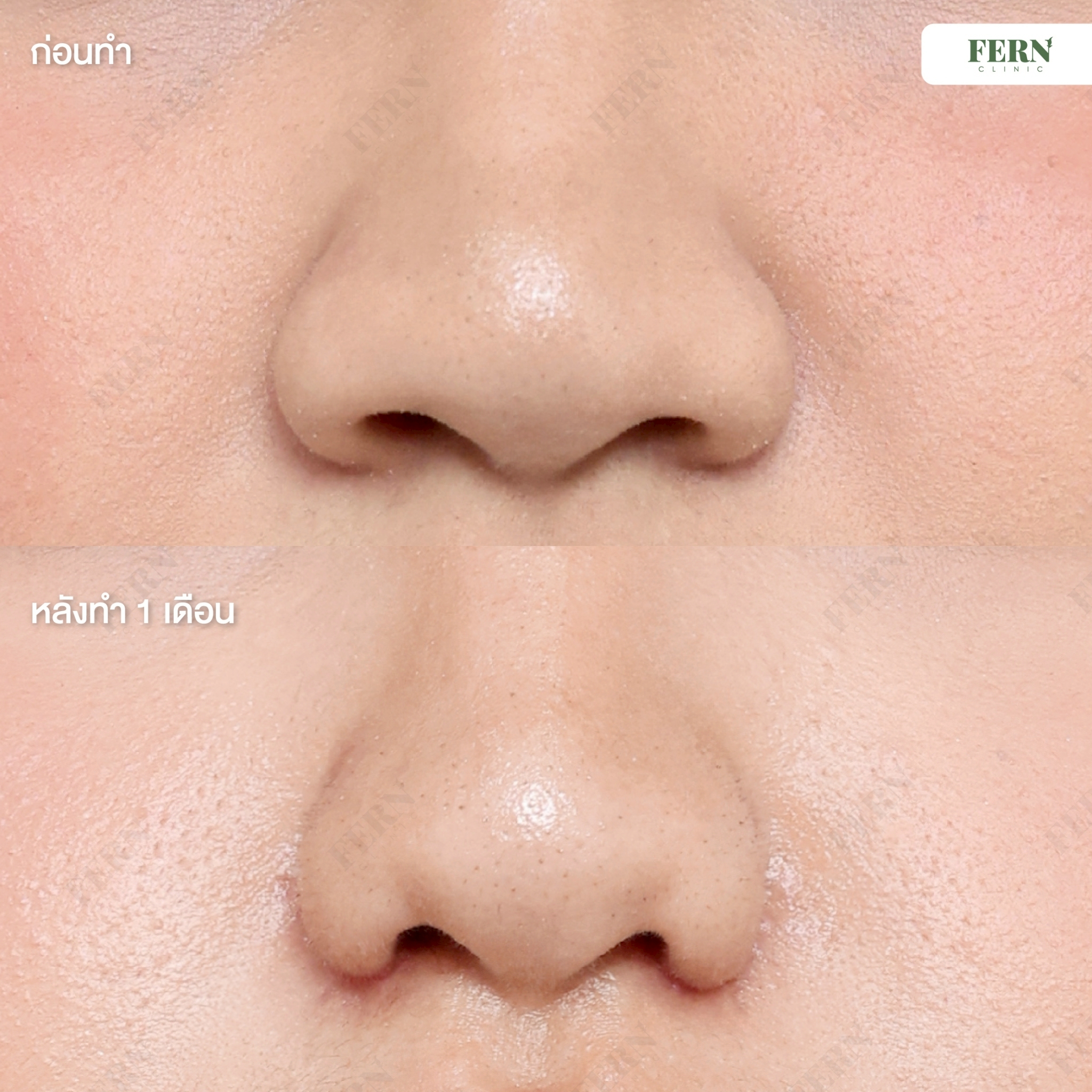 LINE_ALBUM_เคสรีวิว ตัดปีกจมูก_250927_13