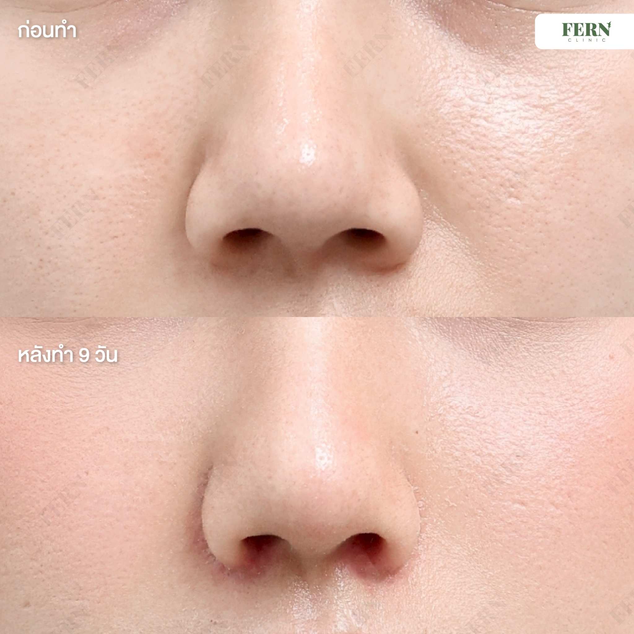 LINE_ALBUM_เคสรีวิว ตัดปีกจมูก_250927_17