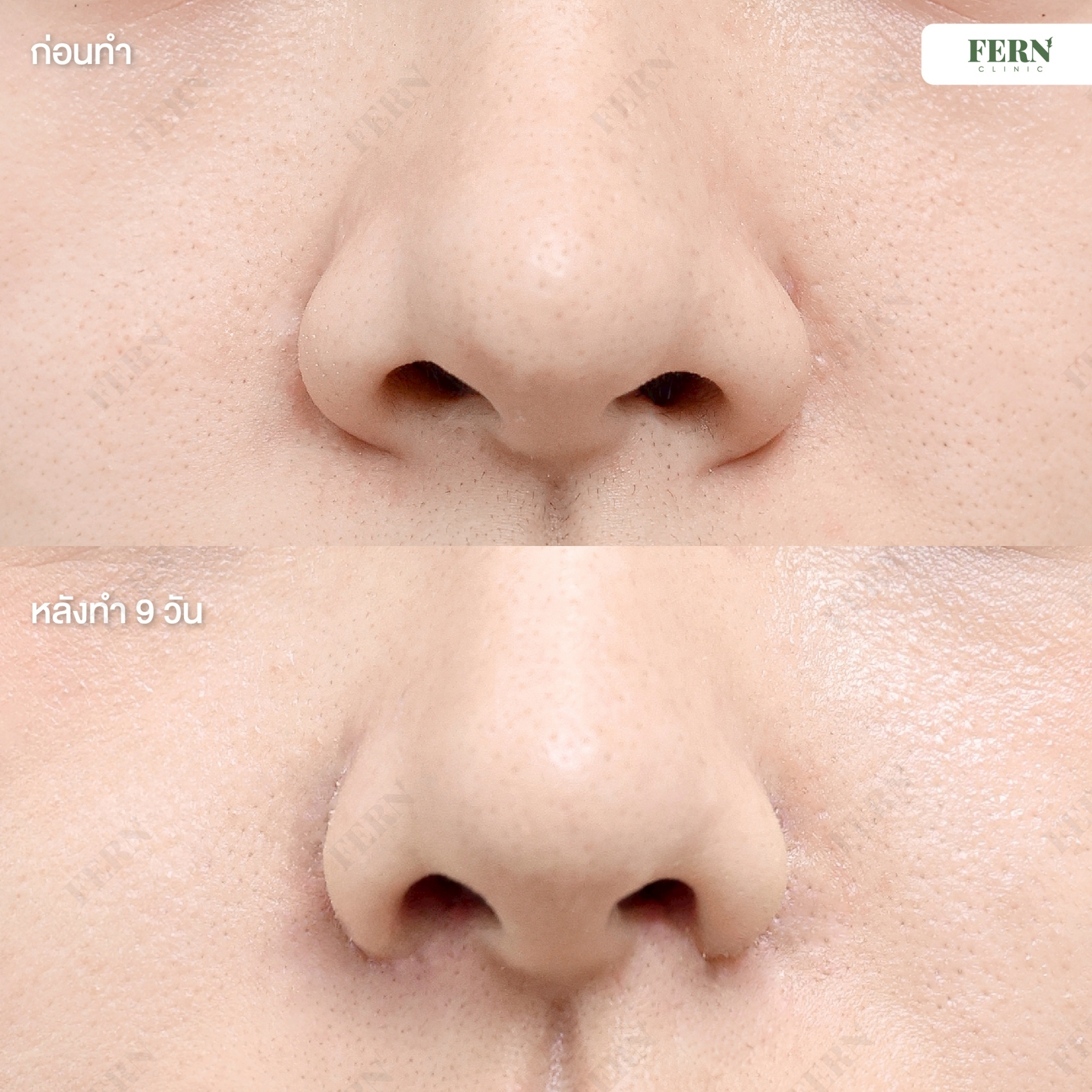 LINE_ALBUM_เคสรีวิว ตัดปีกจมูก_250927_21