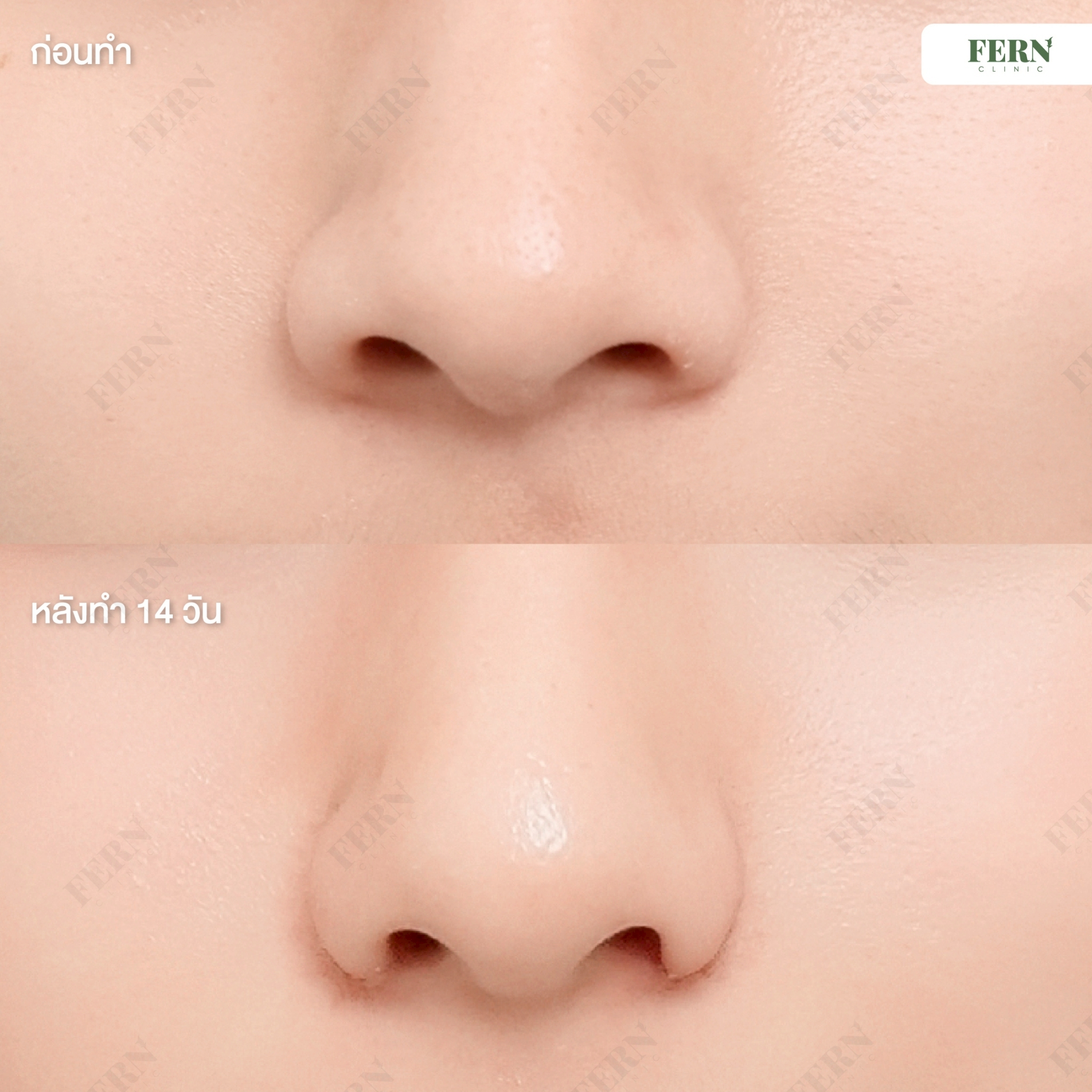 LINE_ALBUM_เคสรีวิว ตัดปีกจมูก_250927_9