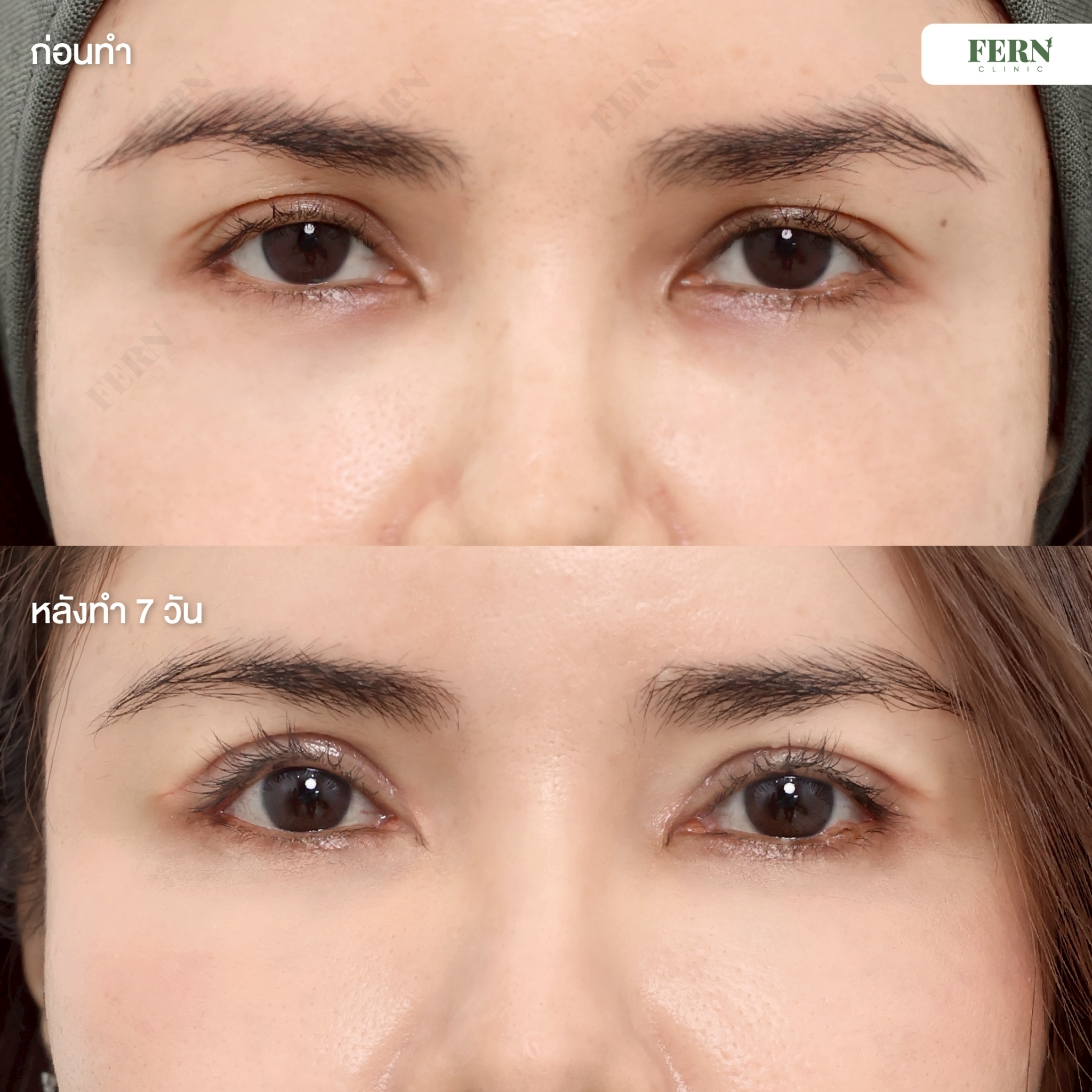 LINE_ALBUM_เคสรีวิว ตาสองชั้น_250927_4