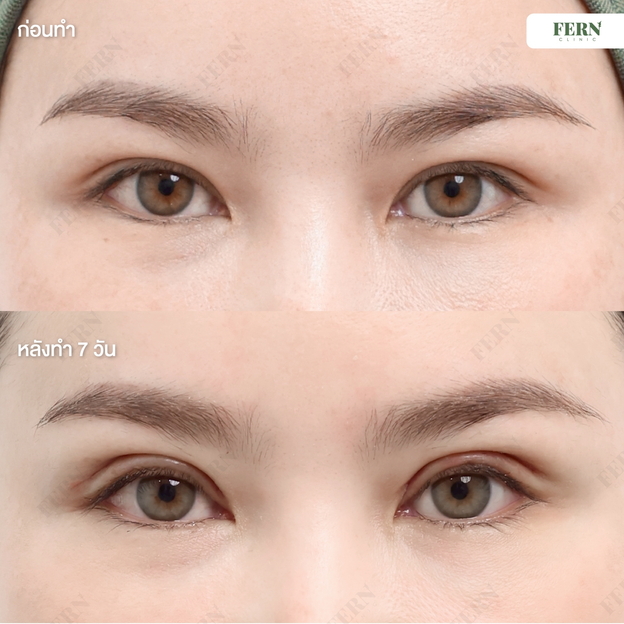 LINE_ALBUM_เคสรีวิว ตาสองชั้น_250927_8