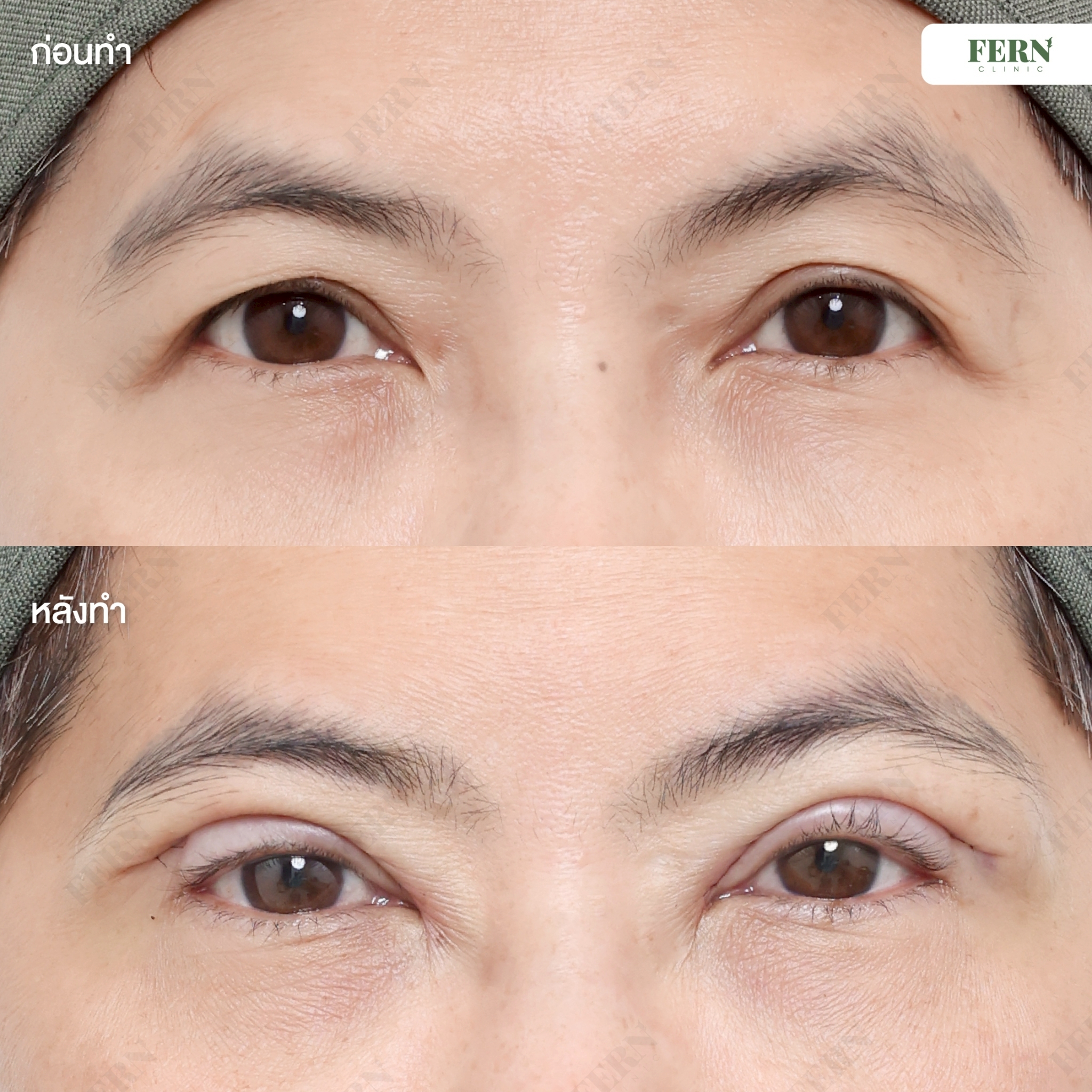 LINE_ALBUM_เคสรีวิว ตาสองชั้น+แก้กล้ามเนื้อตา_250927_12