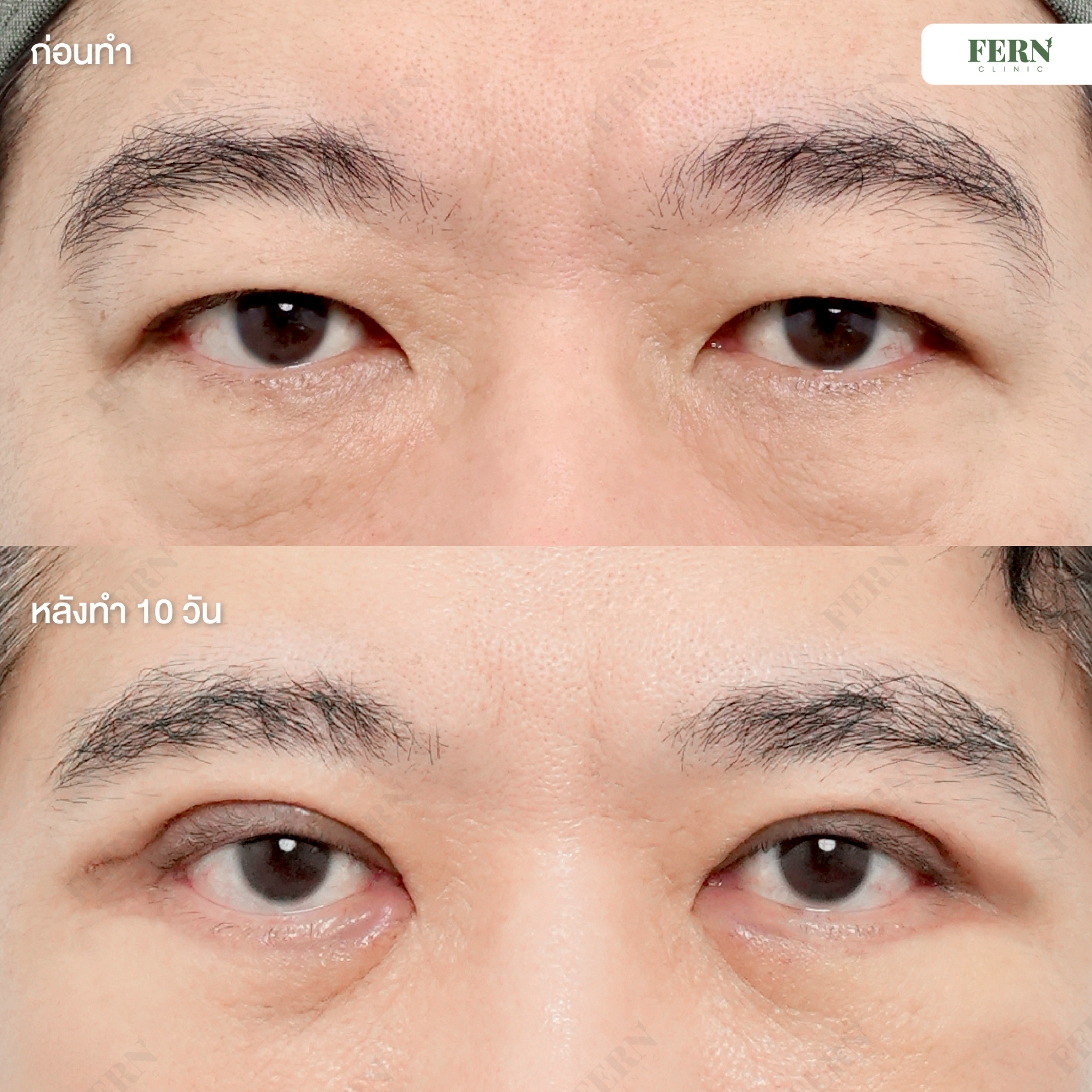 LINE_ALBUM_เคสรีวิว ตาสองชั้น+แก้กล้ามเนื้อตา_250927_9