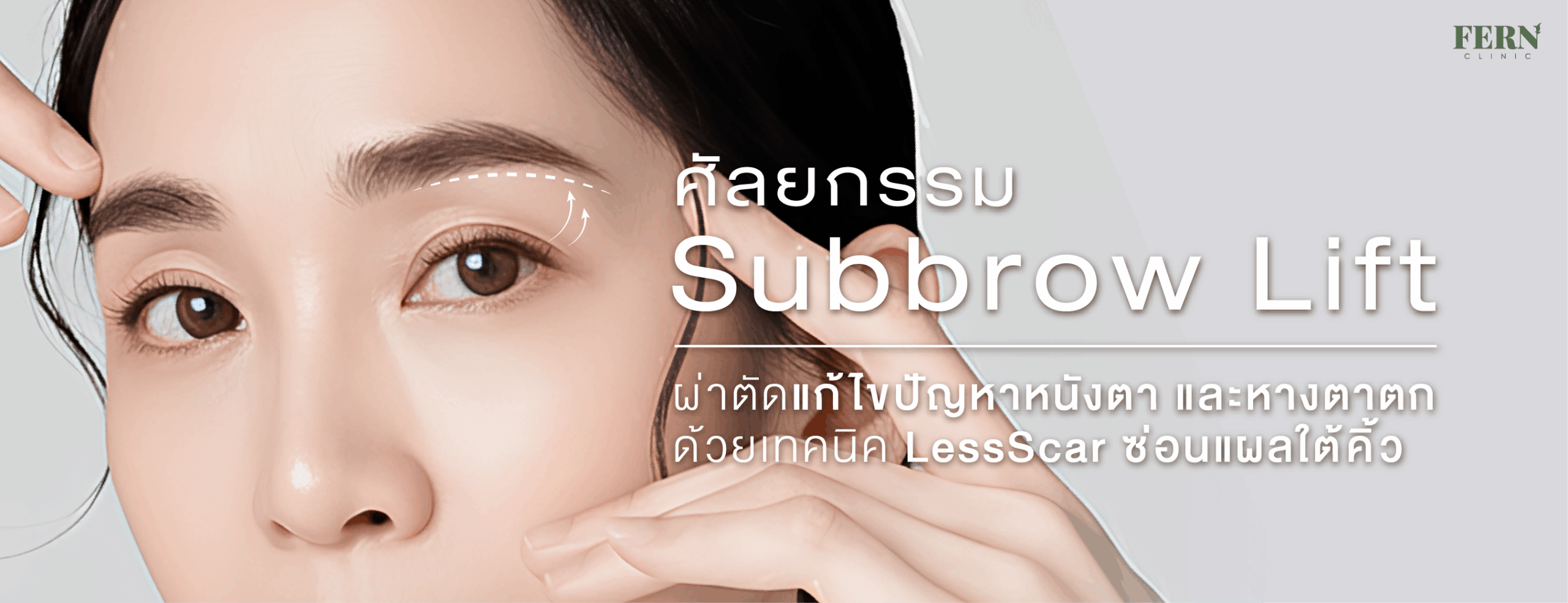ศัลยกรรม Subbrow Lift ผ่าตัดแก้ไขปัญหาหนังตาและหางตาตก ด้วยเทคนิค LessScar ซ่อนแผลใต้คิ้ว