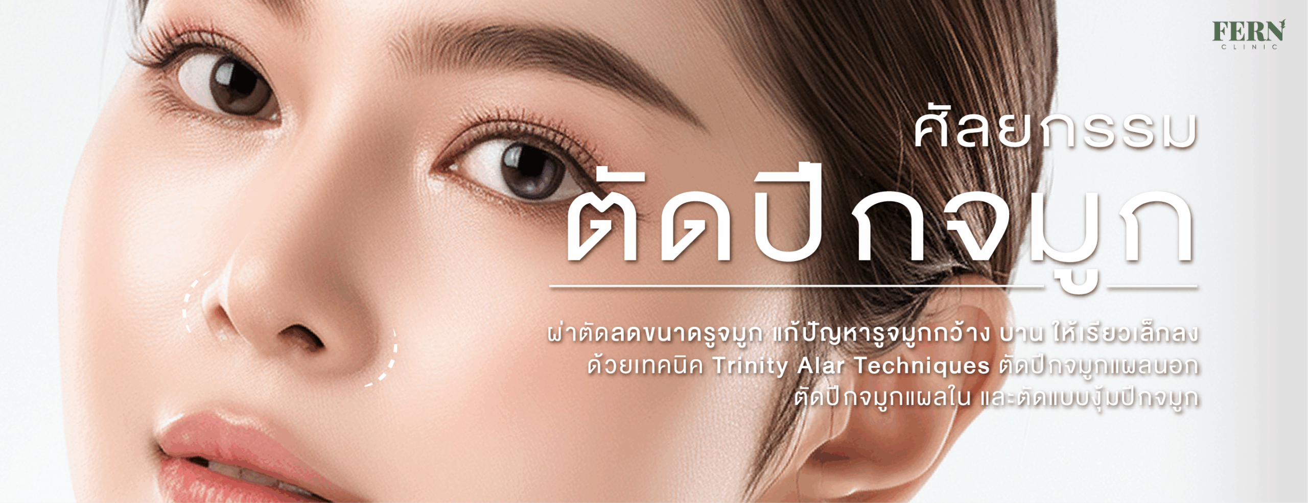 ศัลยกรรมตัดปีกจมูก หรือ แก้ตัดปีกจมูก ผ่าตัดลดขนาดรูจมูก แก้ปัญหารูจมูกกว้าง บาน ให้เรียวเล็กลง ด้วย 3 เทคนิคพร้อมกัน ตัดปีกจมูกแผลนอก ตัดปีกจมูกแผลใน และตัดแบบงุ้มปีกจมูก