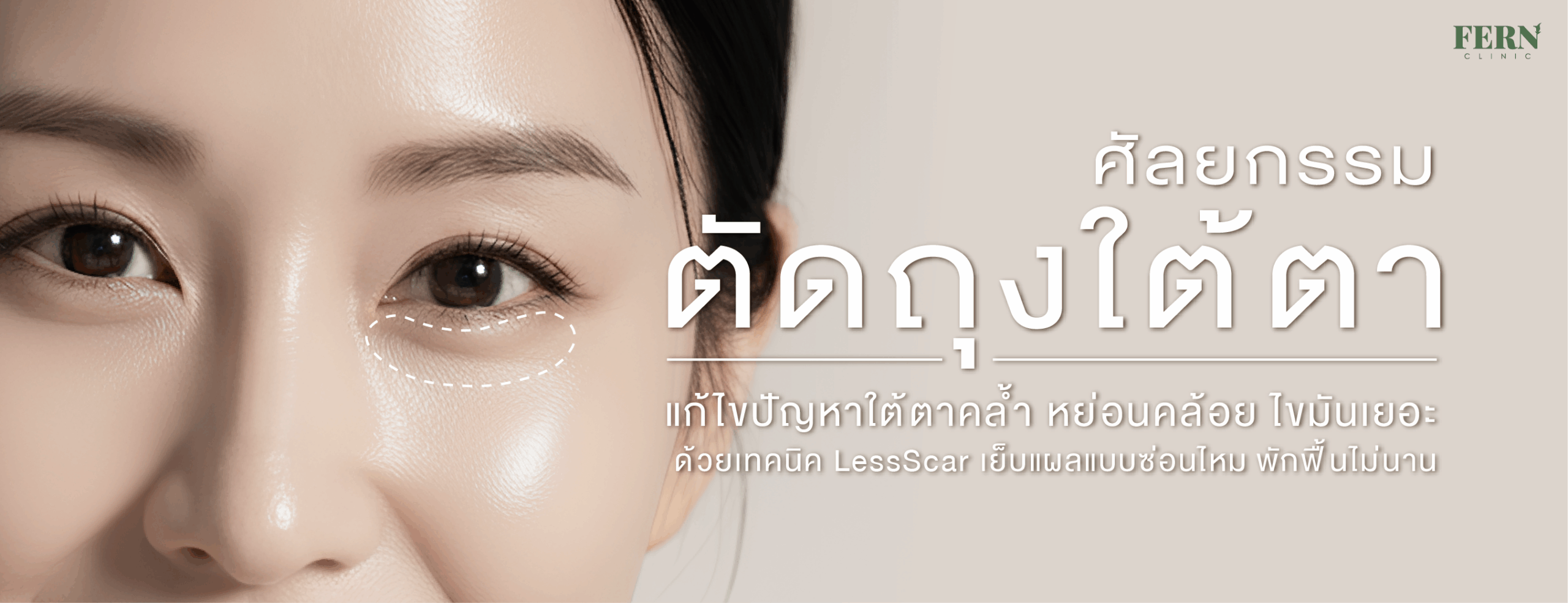 ศัลยกรรมผ่าตัดถุงใต้ตา แก้ไขปัญหาใต้ตาคล้ำ หย่อนคล้อย ไขมันเยอะ ด้วยเทคนิค Less Scar เย็บแผลแบบซ่อนไหม พักฟื้นไม่นาน