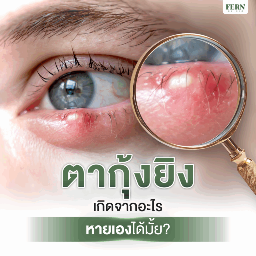 ตากุ้งยิงเกิดจากอะไร หายเองได้ไหม