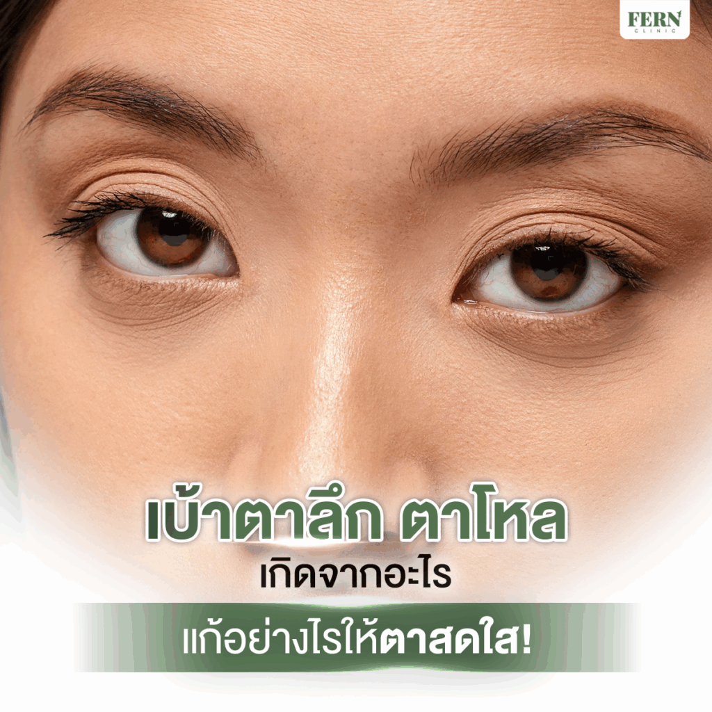 เบ้าตาลึก ตาโหล เกิดจากอะไร แก้อย่างไรให้ตาสดใส